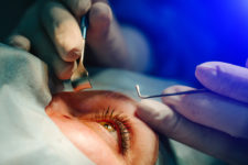 Cataract-surgery