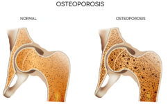 Остеопороз