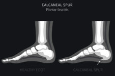 Calcaneal spur